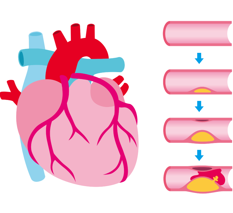 動脈硬化のイメージ