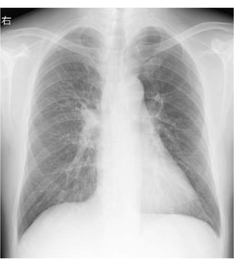 肺がんドックイメージ2